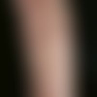 Porokeratosis superficialis disseminata actinica. Chronisch persistierende, asymptomatische, an d...