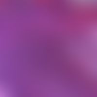 Porom ekkrines. solid tumor clusters sharply separated from the normal epidermis with dense, very...