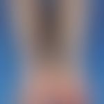 Porphyria cutanea tarda. Ausgeprägte Narbenbildung im Bereich der Unterarme und Handrücken bei ei...
