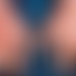 Porphyria cutanea tarda. Schuppende und krustige Veränderungen an Handrücken und Unterarm, flächi...
