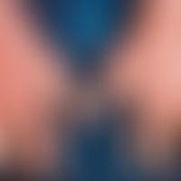 Porphyria cutanea tarda, scaly and crusty changes on the back of the hand and forearm, extensive ...