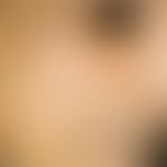 Porphyria cutanea tarda:&nbsp;schmutzig braune Hyperpigmentierungen; Hypertrichose im Bereich der...