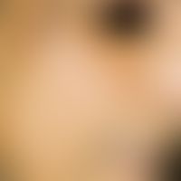 Porphyria cutanea tarda:&nbsp;schmutzig braune Hyperpigmentierungen; Hypertrichose im Bereich der...