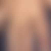 Porphyria cutanea tarda. Hier abgebildet ist eine Detailaufnahme der Hand bei insgesamt generalis...