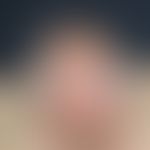 Porphyria cutanea tarda. Flächenhafte Erosionen und Krusten mit "normaler" Heilungstendenz bei 60...