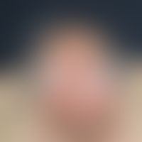 Porphyria cutanea tarda. Flächenhafte Erosionen und Krusten mit "normaler" Heilungstendenz bei 60...