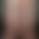 Postthrombotic syndrome, marked increase in circumference, livid discoloration of the right leg, ...