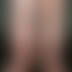Postthrombotic syndrome, marked increase in circumference, livid discoloration of the right leg, ...