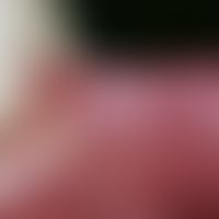 Proptosis buccalis. Chronisch stationäre, seit 1 Jahr bestehende, im Lippenwinkelbereich linkssei...