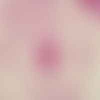 Protothecosis: Prototheca wickerhamii with multiple chambers in the subcutis; PAS staining (PD Dr...