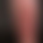 Differenzialdiagnose: Prurigo nodularis

Diagnose: Lichen planus verrucosus:&nbsp; Isolierte und ...