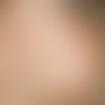 Prurigo simplex acuta infantum: Disseminated, very itchy, inflammatory papules and papulovesicles...