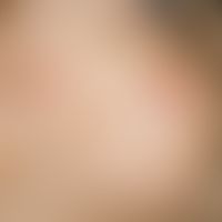 Prurigo simplex acuta infantum: Disseminated, very itchy, inflammatory papules and papulovesicles...