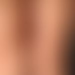 Prurigo simplex acuta infantum: For several days massive progressive, disseminated, agonizingly i...