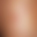 Prurigo simplex subacuta:0.3-0.4 cm large, red, centrally eroded or ulcerated, moderately sharply...