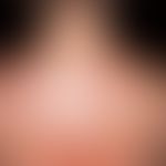 Prurigo simplex subacuta: typicalpattern of distribution with differently sized, always centrally...