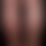 Prurigo simplex subacuta: unusually extensive clinical picture with papules of different sizes, a...