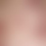 Prurigo simplex subacuta: 54-year-old female patient with a clinical picture that has been progre...