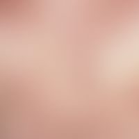 Prurigo simplex subacuta:generalized, permanent clinical picture with disseminated, 0.2-0.5 cm la...