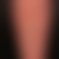 Prurigo simplex subacuata: typicaldistribution pattern of the interval-like itchy, scratched, inf...