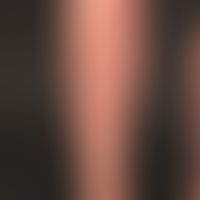Prurigo simplex subacuata: typical distribution pattern of the interval-like itching, scratched, ...