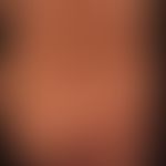 Prurigo simplex subacuata: typicaldistribution pattern of the interval-like itchy, scratched, inf...