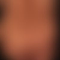 Prurigo simplex subacuata: typicaldistribution pattern of the interval-like itchy, scratched, inf...