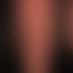 Prurigo simplex subacuta:disseminated scratched, eroded or ulcerated nodules and nodules; severe ...