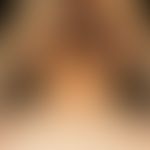 Pseudoacanthosis nigricans: Stripy and reticulated hyperpigmented plaques in the neck of a 16-yea...