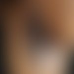 Pseudoacanthosis nigricans: Flat, slightly swollen, hyperpigmented areas of the axils in an obese...