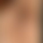 Pseudoacanthosis nigricans: Slightly pronounced, flat, slightly swollen, hyperpigmented areas of ...