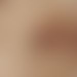 Pseudofolliculitis barbae. reflected light microscopy: Terminal hair ingrown into the skin of the...