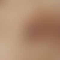 Pseudofolliculitis barbae. reflected light microscopy: Terminal hair ingrown into the skin of the...