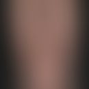 Pseudo-Kaposi-Sarkom. Übersichtsaufnahme: Vereinzelte, solitäre, bläulich-rote, runde Makulae und...
