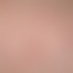 Pseudo-Kaposi's sarcoma Detail magnification: The picture shows a 6 x 5 mm red papule almost cent...