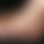 Pseudo-Kaposi's sarcoma: Benign vascular proliferation caused by local changes in circulation (al...