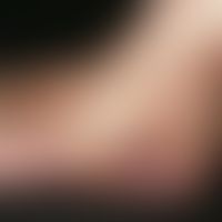 Pseudo-Kaposi-Sarkom. Durch lokale Veränderungen der Zirkulation (veränderte Sauerstoff- und/oder...