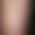 Pseudoleucoderma psoriaticum. white coloration of the skin during cignolin therapy of psoriasis v...