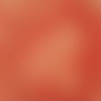 Pseudoleukoderm: ausgesparte helle Flecken inmitten eines kräftigen Erythems. Zustand nach Lokalt...