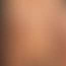 Pseudoleukoderma:&nbsp;multiple, sharply defined bright spots after pityriasis lichenoides chroni...