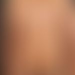 Pseudoleukoderme:&nbsp;multiple, scharf begrenzte helle Flecken nach Pityriasis lichenoides chron...