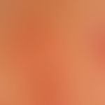 pseudolymphomas of the skin. painless, reddish-brownish papules and nodules with smooth surface o...