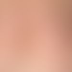 Pseudolymphomas of the skin. multiple, chronically dynamic, for one year existing, increasing in ...