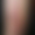 Pseudolymphomas of the skin: Multiple, chronically stationary, disseminated, painless, livid-redd...