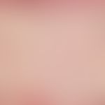 Pseudopélade: atrophying alopecia; connective tissue follicle residue with thinning lymphocytic i...