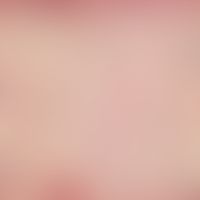 Pseudopélade: atrophying alopecia; connective tissue follicle residue with thinning lymphocytic i...
