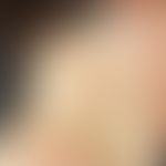 Pseudoxanthoma elasticum. multiple, chronically stationary, long-standing, netted and striped, sl...