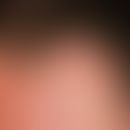 Pseudozyste der Aurikula:&nbsp;solitäre, akute, seit 4 Wochen bestehende, nach stumpfer Verletzun...