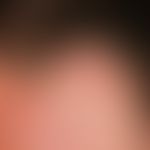 Pseudozyste der Aurikula:&nbsp;solitäre, akute, seit 4 Wochen bestehende, nach stumpfer Verletzun...