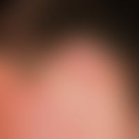Pseudozyste der Aurikula:&nbsp;solitäre, akute, seit 4 Wochen bestehende, nach stumpfer Verletzun...